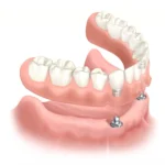 prótesis dental fija sobre implantes dentales en Murcia