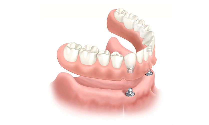 prótesis dental fija sobre implantes dentales en Murcia
