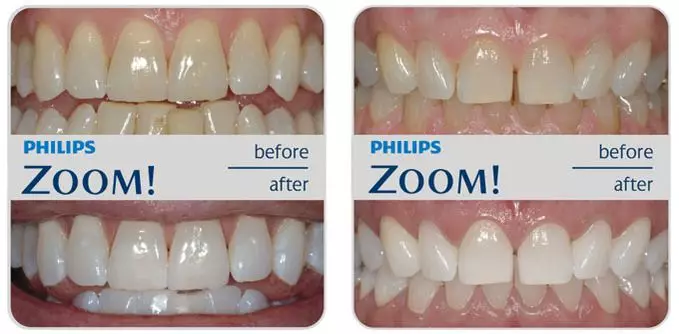 Blanqueamiento Dental Profesional en Murcia