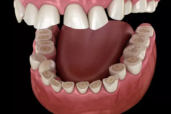 Desgaste de dientes por Bruxismo en Murcia