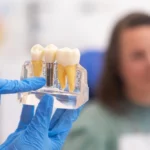 Cuidados de implantes dentales en Murcia