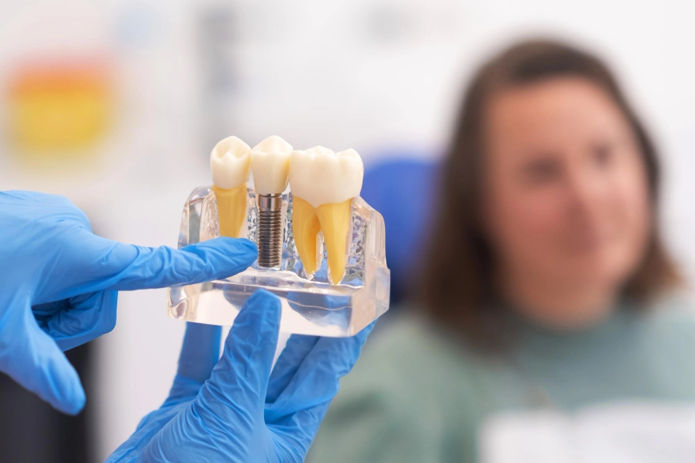 Cuidados de implantes dentales en Murcia