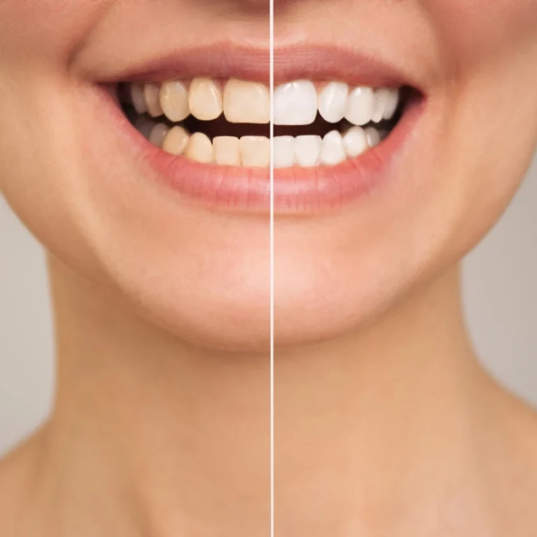 Especialistas en blanqueamiento dental en Murcia