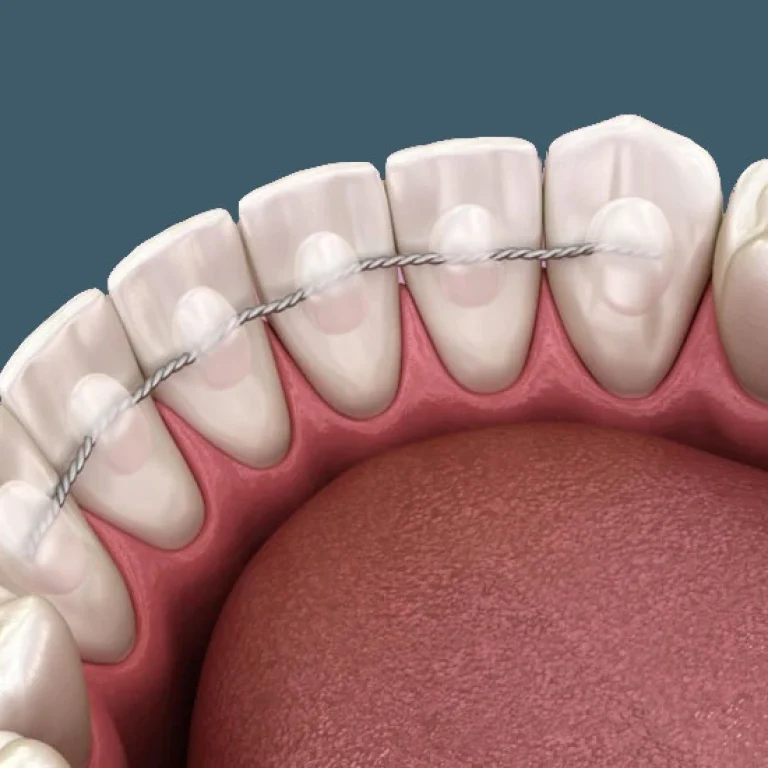 Retenedor fijo en Murcia