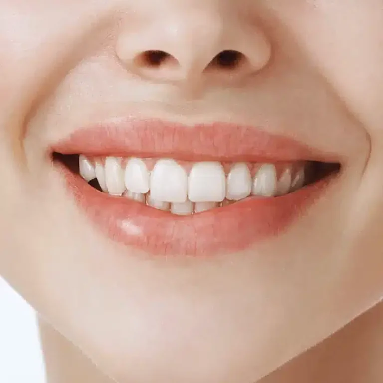 Tratamiento carillas dentales Murcia