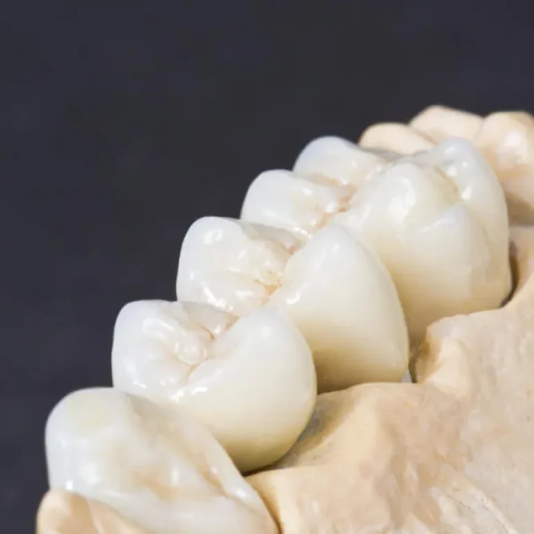 Tratamiento coronas dentales Murcia