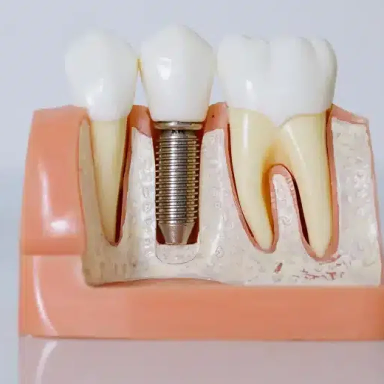 Tratamiento de implantes dentales en Murcia