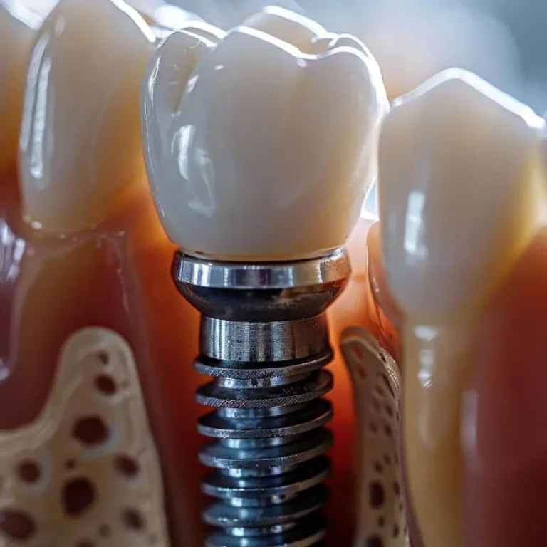 Tratamiento de periimplantitis en Murcia