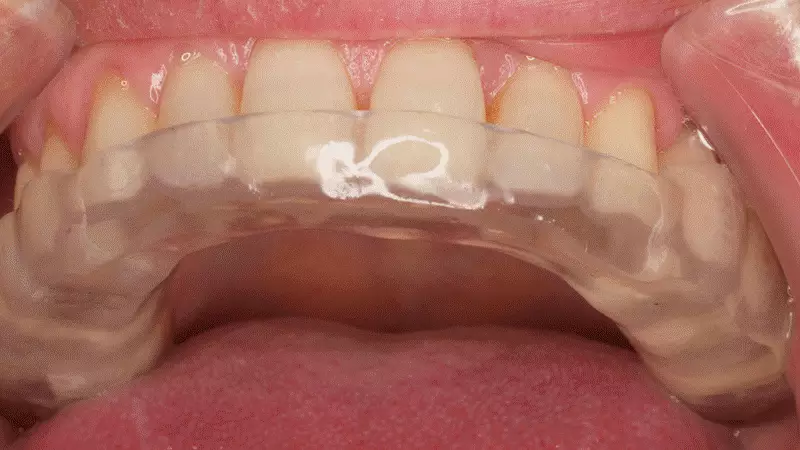 ferula descarga bruxismo murcia