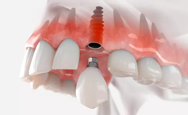 implante-dental-murcia