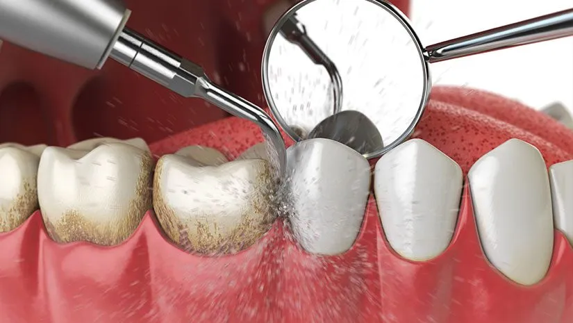 limpieza dental profesional murcia