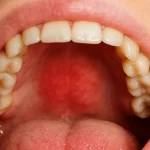 Paladar inflamado Murcia