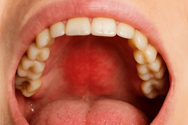 Paladar inflamado Murcia