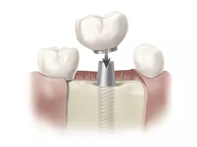 partes-implante-dental-corona