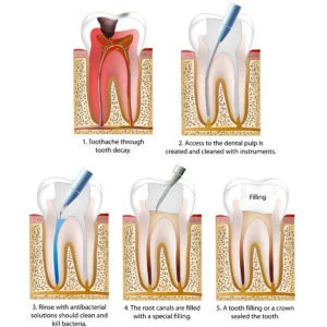 Pasos de una endodoncia en Murcia