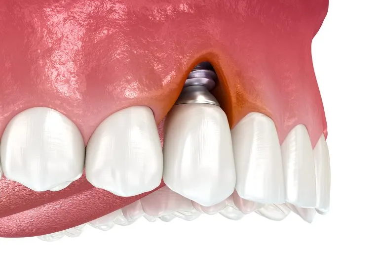 Periimplantitis en Murcia