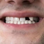 Reponer dientes perdidos en Murcia