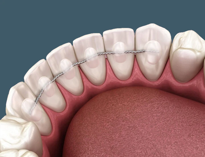 Retenedor fijo en Murcia