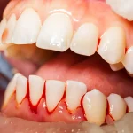 Tratamientos sangre en al saliva en Murcia