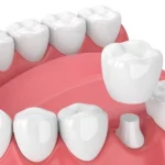 Ventajas de las coronas dentales en Murcia